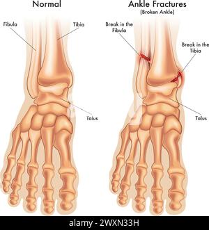 medical illustration compares a normal foot ankle, with a foot ankle fractured in two places, with annotations. Stock Vector