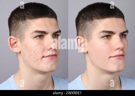 Collage with photos of young man before and after dental treatment ...