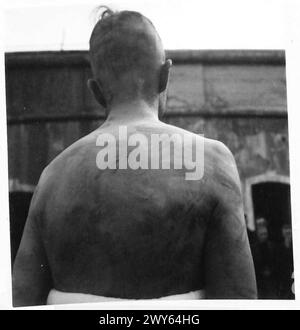 GERMAN ATROCITIES AND TORTURE AGAINST THE BELGIAN PEOPLE. - Bruises on the back of one of the Gestapo's victims. , British Army, 21st Army Group Stock Photo