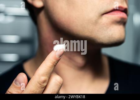 Face cream and lotion. Skin care. Man applying sunscreen, moisturizer or aftershave. Male facial skincare. Moisturizing routine. Treatment for rash. Stock Photo