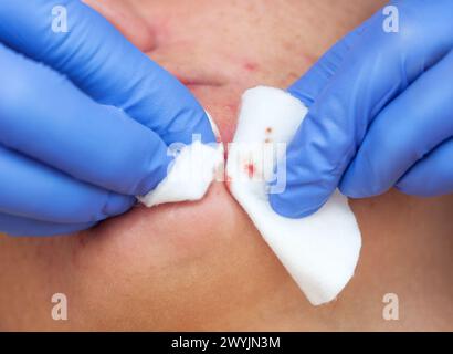 Procedure for cleaning the skin of the face with a steel appliance with a spoon from blackheads and acne. Stock Photo