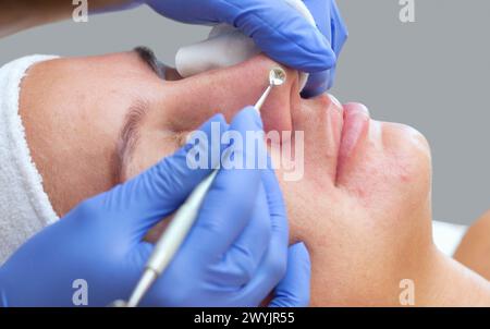 Procedure for cleaning the skin of the face with a steel appliance with a spoon from blackheads and acne. Stock Photo