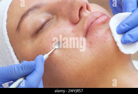 Procedure for cleaning the skin of the face with a steel appliance with a spoon from blackheads and acne. Stock Photo