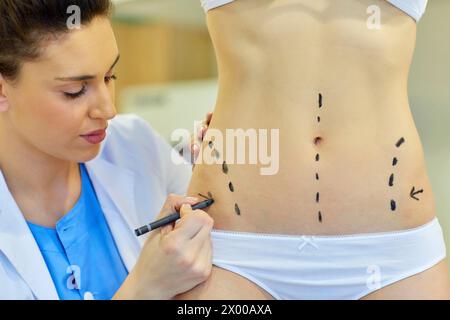 Abdomen. Tummy tuck. It is retensioning skin and abdominal muscles, by removing redundant skin and musculature plication. Before surgery should be taken anatomical references, such as the midline of the abdomen and the height of the anterior superior iliac spine. Plastic surgery. Doctor attending to patient medical consultation. Stock Photo