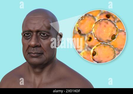 Illustration of lipoma on a man's forehead, and close-up view of adipocytes, the fat cells constituting the lipoma growth. Stock Photo