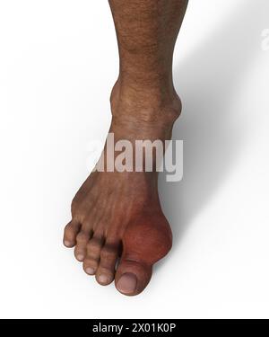 Illustration of a gout-afflicted foot, showcasing inflammation and deformity in the toe joint. Stock Photo