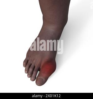 Illustration of a gout-afflicted foot, showcasing inflammation and ...
