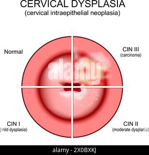 Cervical dysplasia. Close-up of a cervix. Cervical cancer. Cervical intraepithelial neoplasia development from normal tissue and CIN I with mild dyspl Stock Vector