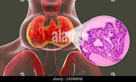 3D illustration of a person with an enlarged thyroid gland (base of ...