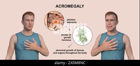 3D illustration comparing a healthy man (left) and the same man with acromegaly (right). Acromegaly is a condition causing an increase in the size of the hands and face due to the overproduction of somatotrophin (human growth hormone). It is typically a result of a benign tumour (adenoma) forming on the pituitary gland. Stock Photo