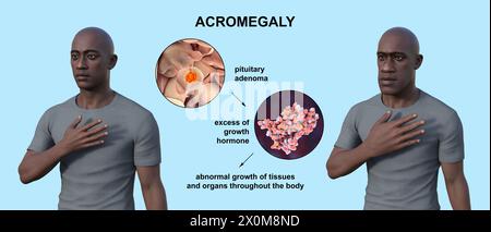 3D illustration comparing a healthy man (left) and the same man with acromegaly (right). Acromegaly is a condition causing an increase in the size of the hands and face due to the overproduction of somatotrophin (human growth hormone). It is typically a result of a benign tumour (adenoma) forming on the pituitary gland. Stock Photo