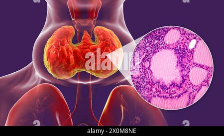 3D illustration of a person with a toxic goitre (enlarged thyroid gland ...