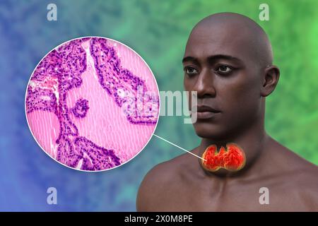 3D illustration of a man with a toxic goitre (enlarged thyroid gland, base of neck), and a close-up of the affected thyroid tissue. A goitre is deemed toxic when the enlarged thyroid gland is also producing excessive thyroid hormone. Stock Photo