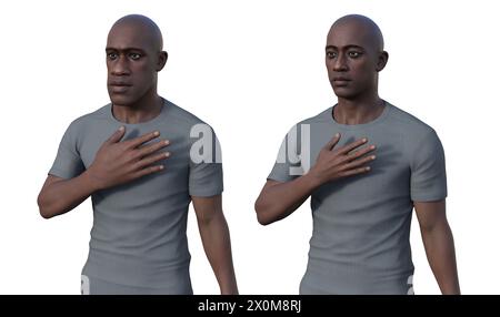 3D illustration comparing a man with acromegaly (left) and the same healthy man (right). Acromegaly is a condition causing an increase in the size of the hands and face due to the overproduction of somatotrophin (human growth hormone). It is typically a result of a benign tumour (adenoma) forming on the pituitary gland. Stock Photo