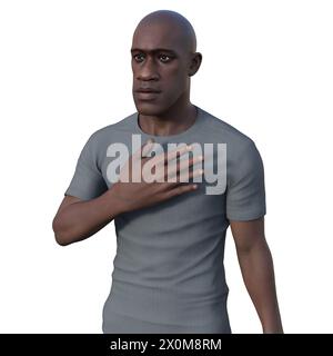 3D illustration of a man with acromegaly. This is a condition causing an increase in the size of the hands and face due to the overproduction of somatotrophin (human growth hormone). It is typically a result of a benign tumour (adenoma) forming on the pituitary gland. Stock Photo