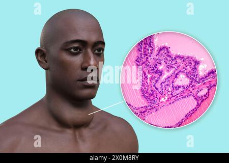 3D illustration of a man with a toxic goitre (enlarged thyroid gland, base of neck), and a close-up of the affected thyroid tissue. A goitre is deemed toxic when the enlarged thyroid gland is also producing excessive thyroid hormone. Stock Photo