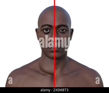 Medical illustration of exophthalmos, bulging of the eyes Stock Photo ...