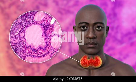 3D illustration of a man with an enlarged thyroid gland (goitre, base of neck), and a close-up of the affected thymus tissue. Stock Photo