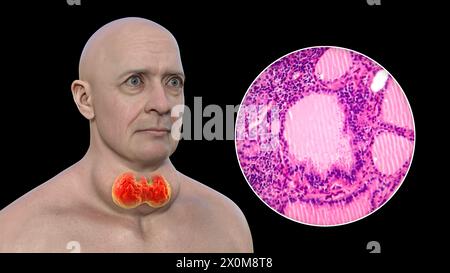 3D illustration of a man with a toxic goitre (enlarged thyroid gland, base of neck), and a close-up of the affected thyroid tissue. A goitre is deemed toxic when the enlarged thyroid gland is also producing excessive thyroid hormone. Stock Photo