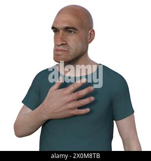3D illustration of a man with acromegaly. This is a condition causing an increase in the size of the hands and face due to the overproduction of somatotrophin (human growth hormone). It is typically a result of a benign tumour (adenoma) forming on the pituitary gland. Stock Photo