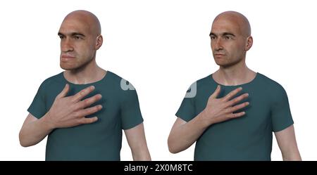 3D illustration comparing a man with acromegaly (left) and the same healthy man (right). Acromegaly is a condition causing an increase in the size of various body parts including the facial features. It is caused by the overproduction of somatotrophin (human growth hormone) typically resulting from a benign tumour (adenoma) forming on the pituitary gland. Stock Photo