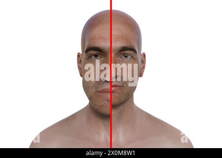 3D illustration comparing a man with acromegaly (left) and the same healthy man (right). Acromegaly is a condition causing an increase in the size of various body parts including the facial features. It is caused by the overproduction of somatotrophin (human growth hormone) typically resulting from a benign tumour (adenoma) forming on the pituitary gland. Stock Photo