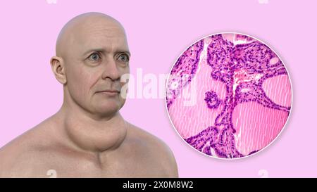 3D illustration of a man with a toxic goitre (enlarged thyroid gland, base of neck), and a close-up of the affected thyroid tissue. A goitre is deemed toxic when the enlarged thyroid gland is also producing excessive thyroid hormone. Stock Photo