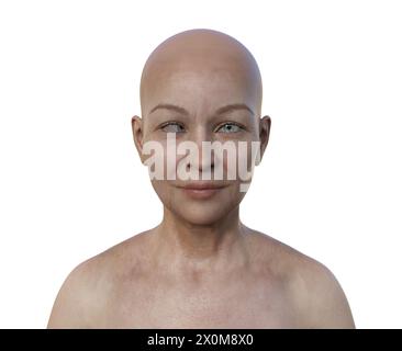 Illustration of a woman with esotropia showing inward eye misalignment. Stock Photo