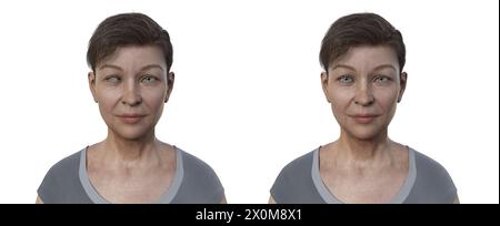 Illustration of a woman with esotropia showing inward eye misalignment and the same healthy woman. Stock Photo