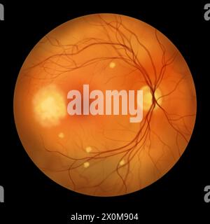 Illustration of a retina affected by blastomycosis as seen during ...