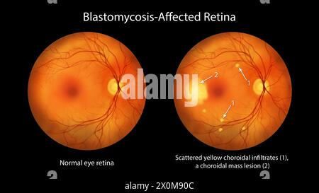 Illustration of a retina affected by blastomycosis as seen in ...