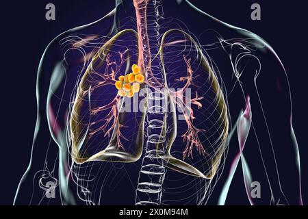 3D illustration of lungs affected by mediastinal lymphadenopathy . This ...