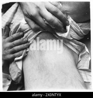 GERMAN ATROCITIES AND TORTURE AGAINST THE BELGIAN PEOPLE. - The skin at the fork was broken as this picture shows. Photographic negative , British Army, 21st Army Group Stock Photo