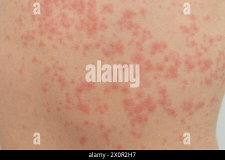 Urticaria is an allergic reaction on the skin. Red spots on the skin. Stock Photo