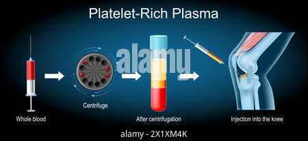 Platelet-rich plasma procedure. Osteoarthritis treatment. Syringe and Human knee joint with inflammation. PRP injection. therapy of joint pain. Regene Stock Vector