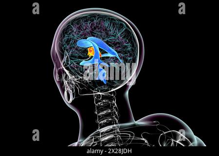 Enlargement of the third brain ventricle, illustration Stock Photo