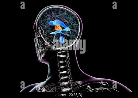Enlargement of the third brain ventricle, illustration Stock Photo