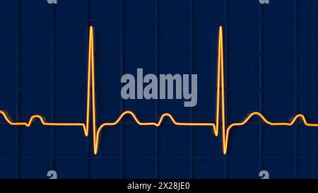 ECG displaying first degree AV block, illustration Stock Photo