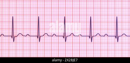 ECG displaying first degree AV block, illustration Stock Photo