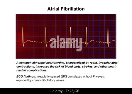ECG in atrial fibrillation, illustration Stock Photo