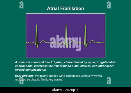 ECG in atrial fibrillation, illustration Stock Photo