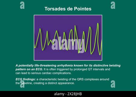 ECG displaying Torsades de pointes rhythm, illustration Stock Photo - Alamy