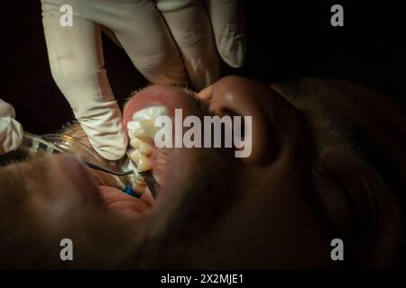 Latin American adult male (42) is seen by a dentist, who performs a resin procedure to repair the damage caused by a caries in a molar tooth. Concept Stock Photo