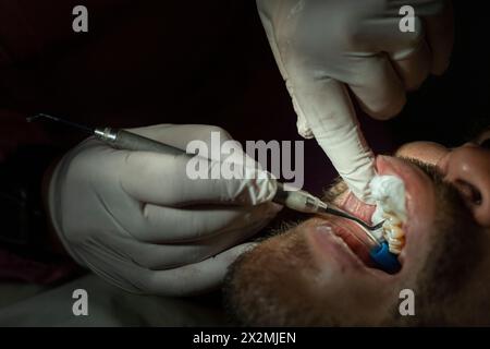 Latin American adult male (42) is seen by a dentist, who performs a resin procedure to repair the damage caused by a caries in a molar tooth. Concept Stock Photo
