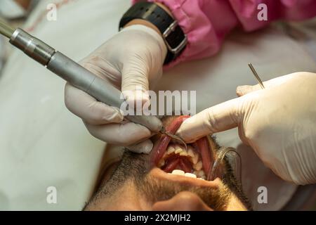Latin American adult male (42) undergoes an ultrasonic tooth cleaning machine procedure to remove dental calculus from his teeth. Concept of health an Stock Photo