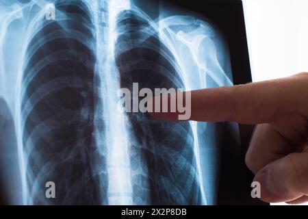 Lung radiography concept. Radiology doctor examining at chest x ray film of patient Lung Cancer or Pneumonia. Virus and bacteria infected the Human Stock Photo