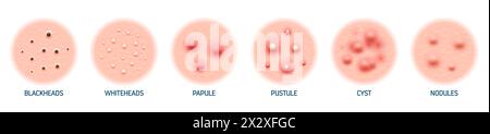 Body skin acne type blackheads, whiteheads, papule, pustule, cyst and nodules. Realistic 3d vector skin conditions characterized by inflamed sebaceous glands, leading to pimples on face or back Stock Vector