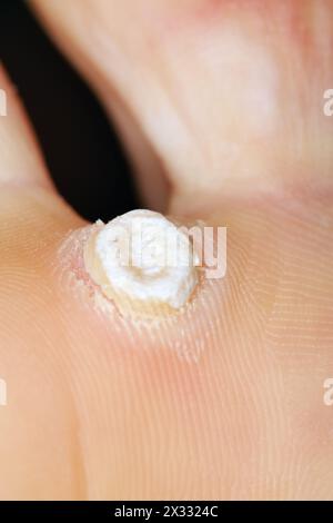 Falling off wart on sole of female feet. Wart - benign skin growths of viral etiology Stock Photo