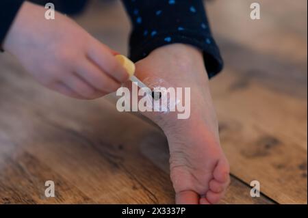 Treatment of warts on the sole of a six year old girl. Stock Photo