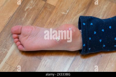 Two warts on the sole of a six year old girl. Stock Photo